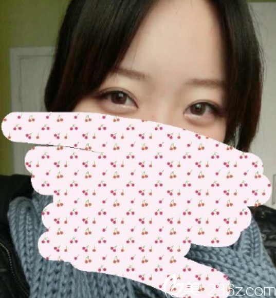 在韓國MVP整形外科玄炅倍做的開眼角價格1萬2，不得不承認(rèn)是美了感覺鼻梁變挺了