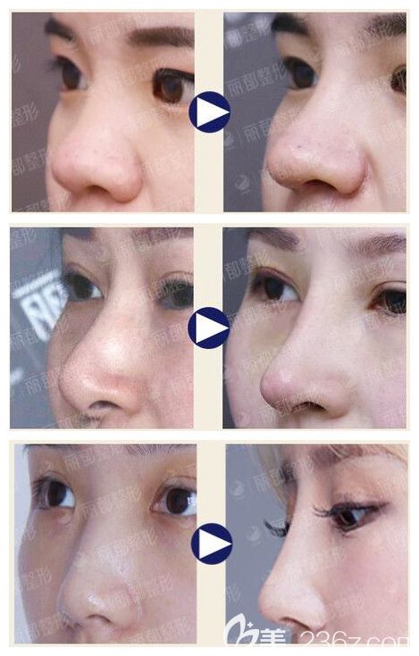 無錫麗都隆鼻案例對(duì)比