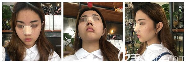 剛做完鼻綜合術(shù)后效果圖