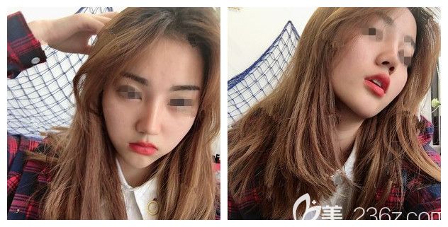 拆線后硅膠假體隆鼻+耳軟骨墊鼻尖恢復(fù)