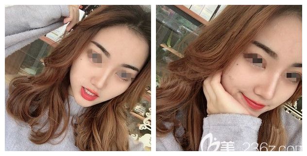 做硅膠假體隆鼻+耳軟骨墊鼻尖術(shù)后20天恢復(fù)