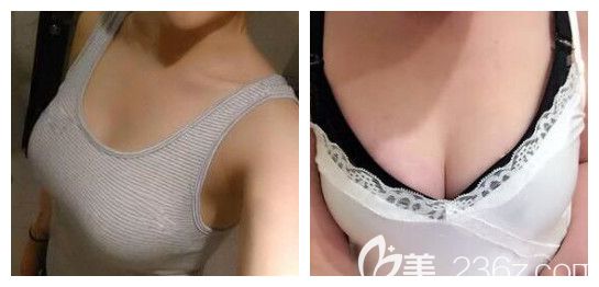 南寧正規(guī)豐胸醫(yī)院是哪家?本人在南寧韓星整形做自體脂肪隆胸,恢復(fù)30天效果是這樣的...