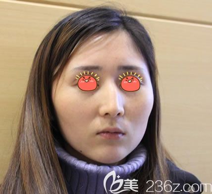 做自體脂肪填充面部之前 做自體脂肪填充面部之前