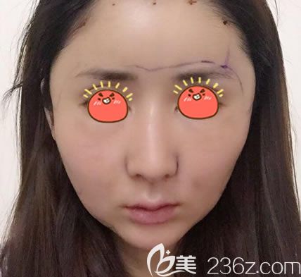 溫州瑞麗剛做完脂肪填充的圖片 溫州瑞麗剛做完脂肪填充的圖片