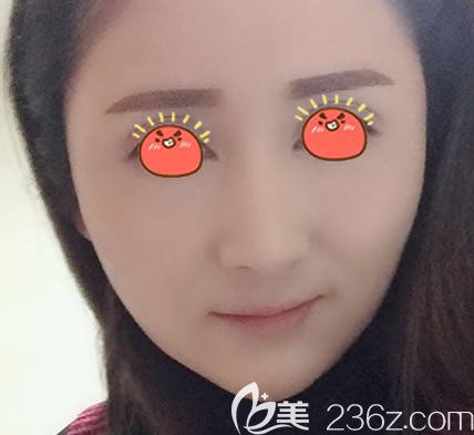 瑞安瑞麗自體脂肪填充30天后 瑞安瑞麗自體脂肪填充30天后