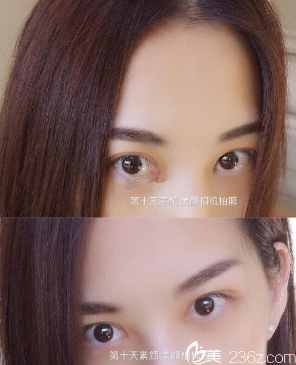 在韓國首爾江南三星醫(yī)院做的埋線雙眼皮內(nèi)眼角提升價格七千左右很滿意