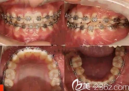 我來(lái)說(shuō)下昆明牙齒矯正哪家醫(yī)院好?本人在德系(雅度)口腔做過(guò)金屬托槽矯正后擺脫了牙性+骨性地包天