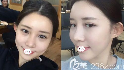 自體脂肪面部填充恢復(fù)期是多久？韓國(guó)歐米茄整形醫(yī)院生機(jī)脂肪移植+鼻綜合案例圖見證