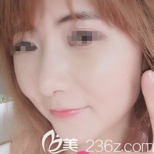 做完國(guó)產(chǎn)恒生線雕術(shù)后半個(gè)月效果