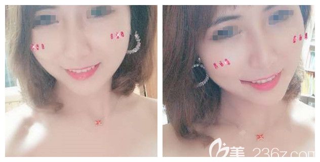 分不清楚的威寧線、韓國優(yōu)雅斯、美迪塑線材，沒想到建議了性價比較高的國產(chǎn)HS恒生下面部線雕