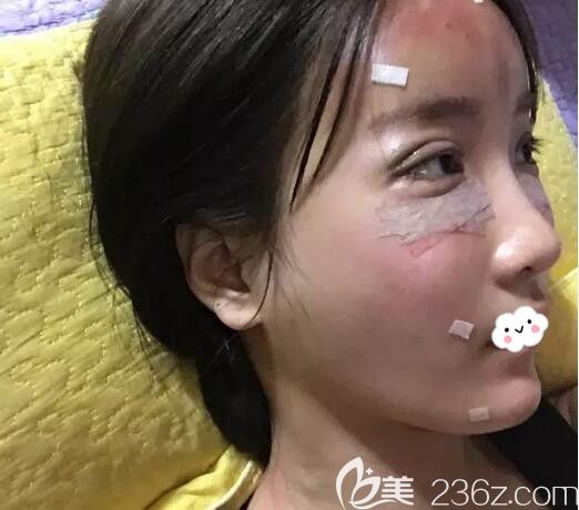 韓國歐米茄去眼袋+去黑眼圈術后第2天恢復圖