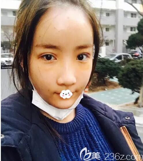 韓國歐米茄晶透下眼皮整形去眼袋+黑眼圈后擁有臥蠶