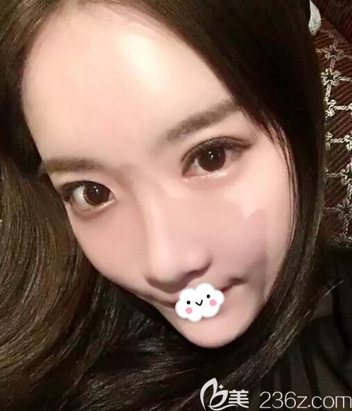 韓國去眼袋+去黑眼圈術后20天恢復效果圖