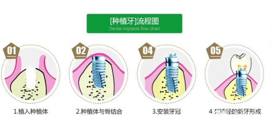 王杰擅長項(xiàng)目種植牙手術(shù) 王杰擅長項(xiàng)目種植牙手術(shù)