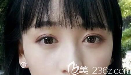  誰說割出來的雙眼皮很假,來看我找曲靖靖美張金明做全切雙眼皮+開眼角的效果怎么樣