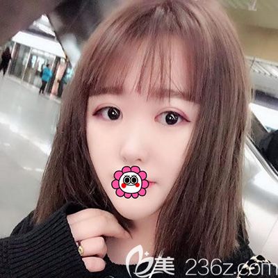 哈爾濱索菲劉剛做的芭比眼綜合恢復(fù)30天效果，大家覺著怎么樣？