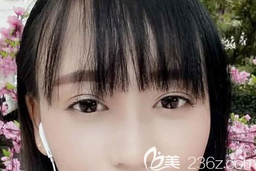 切開(kāi)雙眼皮已經(jīng)20天沒(méi)有肉條增生的現(xiàn)象