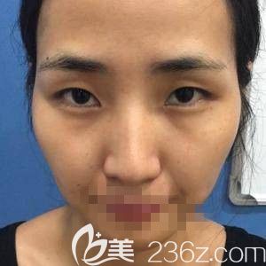 楊瑞國(guó)醫(yī)生做雙眼皮加開(kāi)眼角前 楊瑞國(guó)醫(yī)生做雙眼皮加開(kāi)眼角前