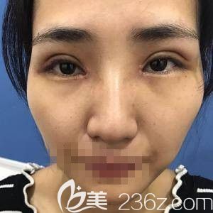 楊瑞國(guó)醫(yī)生做雙眼皮加開(kāi)眼角當(dāng)天 楊瑞國(guó)醫(yī)生做雙眼皮加開(kāi)眼角當(dāng)天