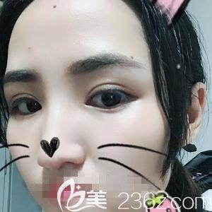 楊瑞國(guó)醫(yī)生做雙眼皮加開(kāi)眼角2周 楊瑞國(guó)醫(yī)生做雙眼皮加開(kāi)眼角2周