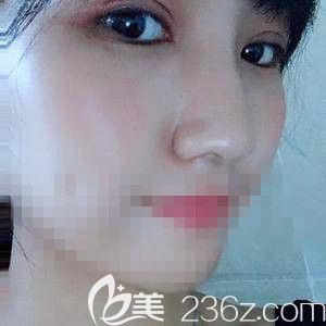 楊瑞國(guó)醫(yī)生做雙眼皮加開(kāi)眼角1個(gè)月 楊瑞國(guó)醫(yī)生做雙眼皮加開(kāi)眼角1個(gè)月