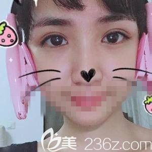 做雙眼皮加開眼角后 隨便發(fā)了一張照片大家居然說我P圖了吧