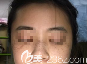 在濰坊做激光祛斑術(shù)后第2天的樣子