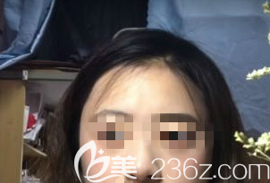 在濰坊做激光祛斑術(shù)后40天的樣子