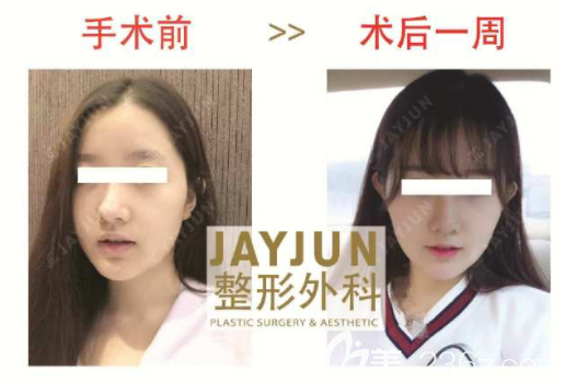 金起完 鼻子真人案例 金起完 鼻子真人案例