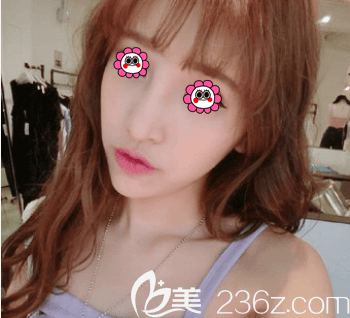 我在北京新星靚做玻尿酸填充蘋果肌前樣子 我在北京新星靚做玻尿酸填充蘋果肌前樣子