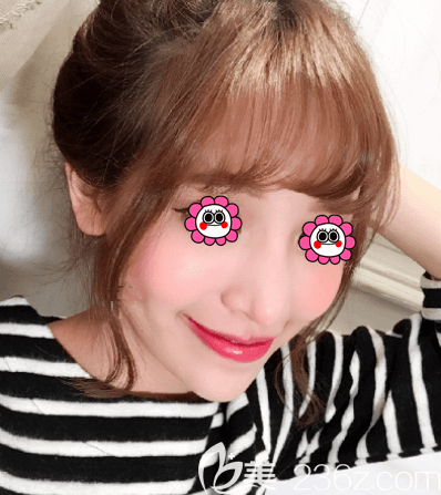 李偉民醫(yī)生給我做玻尿酸填充蘋果肌第15天效果 李偉民醫(yī)生給我做玻尿酸填充蘋果肌第15天效果