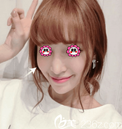 北京新星靚李偉民玻尿酸填充蘋果肌案例 北京新星靚李偉民玻尿酸填充蘋果肌案例