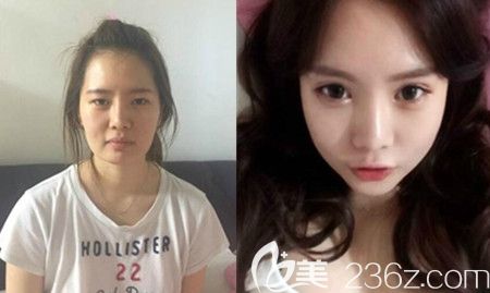 金起完 輪廓真人案例 金起完 輪廓真人案例