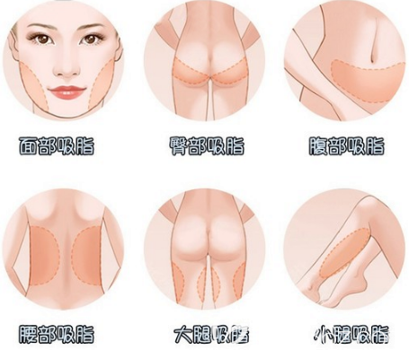 中信惠州醫(yī)院整形科吸脂項目 中信惠州醫(yī)院整形科吸脂項目