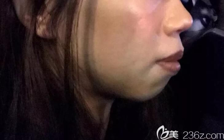 嘴凸齙牙在上海雅悅口腔矯正1年臉型變化很大，有對比圖為證