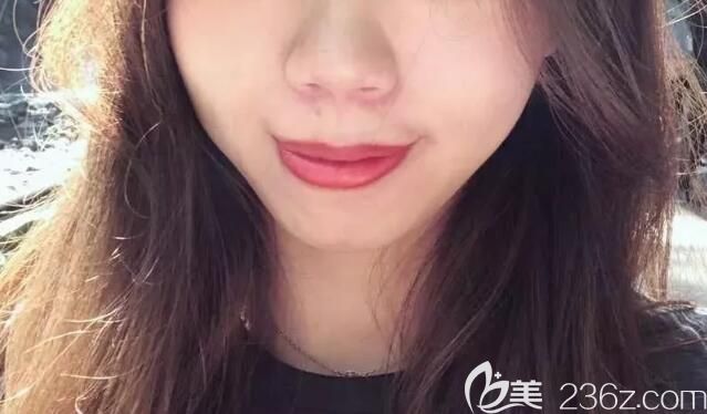 嘴凸齙牙矯正前正面的樣子