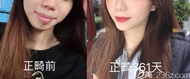 牙齒矯正361天前后對比照