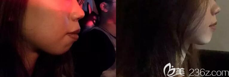 ▼齙牙矯正365天側臉前后變化對比圖