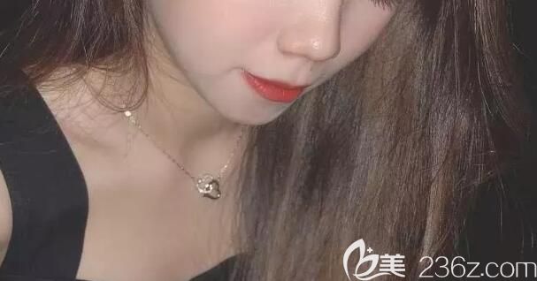 雅悅口腔矯正齙牙1年臉型圖