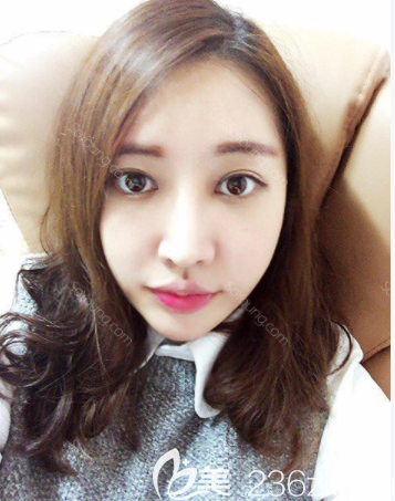 駝峰鼻韓國(guó)JAYJUN整形外科眼鼻部手術(shù)額頭脂肪填充維納斯激光溶脂4周從呆呆女變成可愛(ài)小姐姐