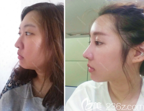 韓國(guó)JAYJUN整形外科醫(yī)院眼鼻真人案例 韓國(guó)JAYJUN整形外科醫(yī)院眼鼻真人案例