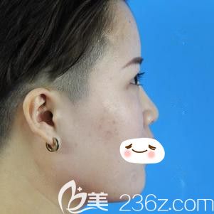 在石家莊天伊美注射隆鼻前是塌鼻子 在石家莊天伊美注射隆鼻前是塌鼻子