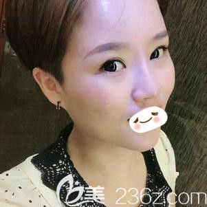 在石家莊天伊美注射愛芙萊玻尿酸后鼻子高挺 在石家莊天伊美注射愛芙萊玻尿酸后鼻子高挺