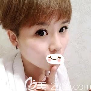 趙彥光醫(yī)生為我注射愛芙萊玻尿酸后6天鼻子已經(jīng)消腫 趙彥光醫(yī)生為我注射愛芙萊玻尿酸后6天鼻子已經(jīng)消腫