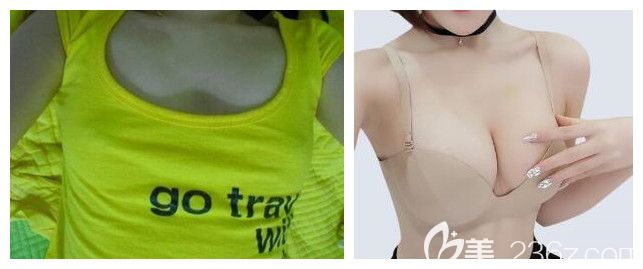 太原時光整形曼托假體隆胸案例