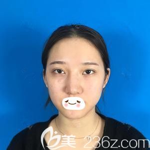 在石家莊天伊美做自體軟骨隆鼻術(shù)前是塌鼻子 在石家莊天伊美做自體軟骨隆鼻術(shù)前是塌鼻子