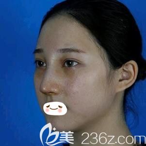 張柏松醫(yī)生為我做自體軟骨隆鼻術(shù)后即刻效果 張柏松醫(yī)生為我做自體軟骨隆鼻術(shù)后即刻效果