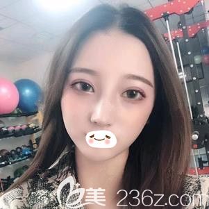 在石家莊天伊美做自體肋軟骨隆鼻術(shù)后10天鼻子微腫 在石家莊天伊美做自體肋軟骨隆鼻術(shù)后10天鼻子微腫