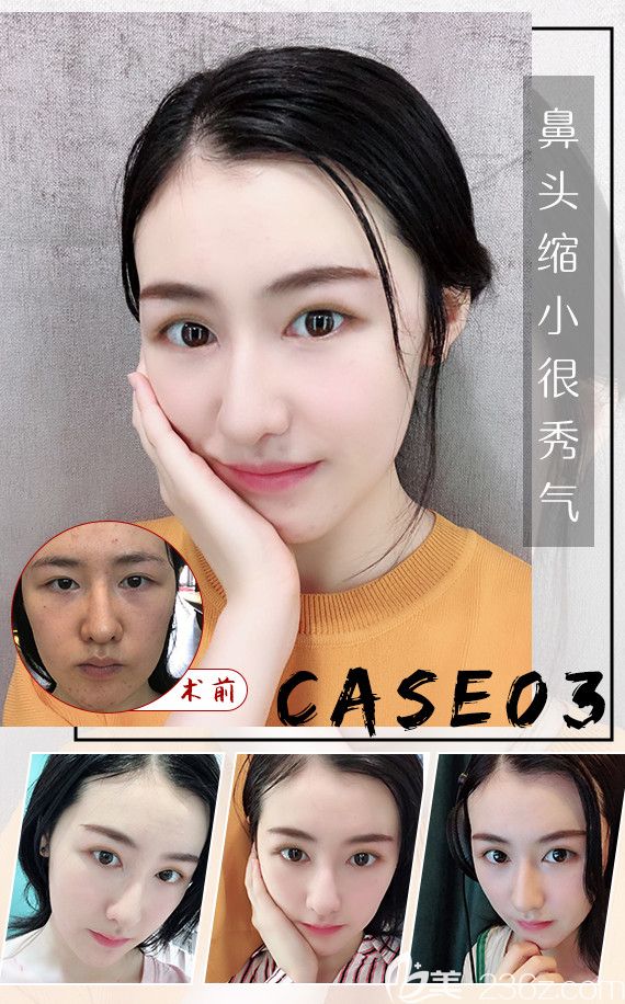 在揚(yáng)州美貝爾做鼻綜合案例