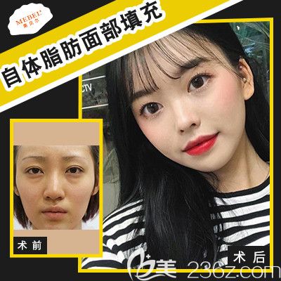 揚(yáng)州美貝爾618年中大促價(jià)目表已出：鼻綜合3880皮秒激光2980，點(diǎn)擊來看吸脂豐胸是否有優(yōu)惠